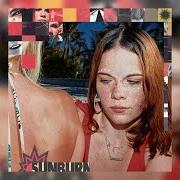 Sunburn