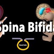 Spina Bifida